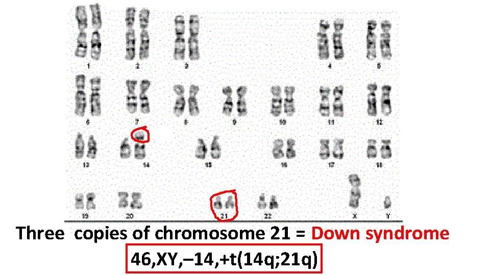 Three copies of chromosome 21 = Down syndrome 46, XY, – 14, +t(14 q;
