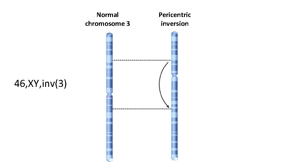 Normal chromosome 3 46, XY, inv(3) Pericentric inversion 