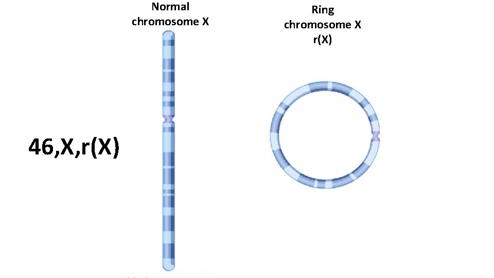 Normal chromosome X 46, X, r(X) Ring chromosome X r(X) 