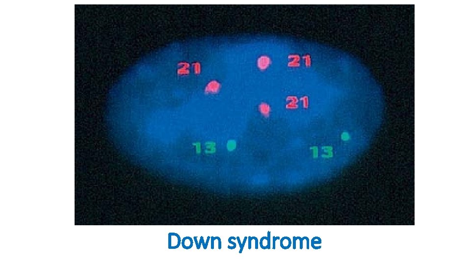 Down syndrome 