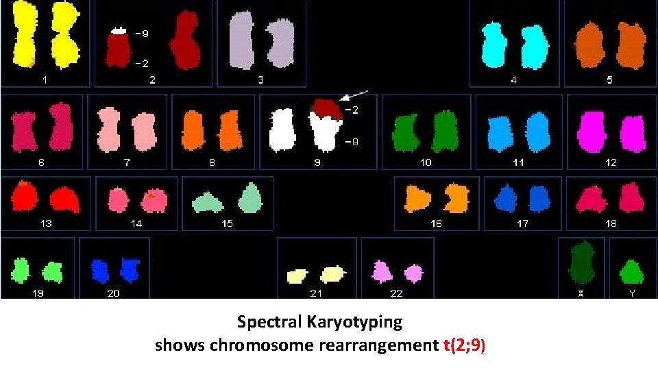 Spectral Karyotyping shows chromosome rearrangement t(2; 9) 