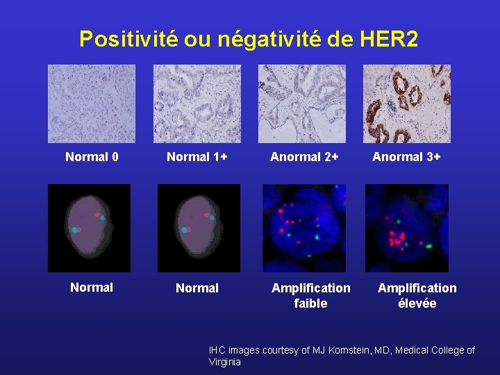 Positivité ou négativité de HER 2 Normal 0 Normal 1+ Normal Anormal 2+ Amplification