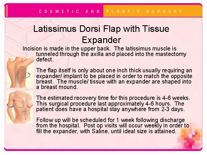 Latissimus Dorsi Flap with Tissue Expander Incision is made in the upper back. The