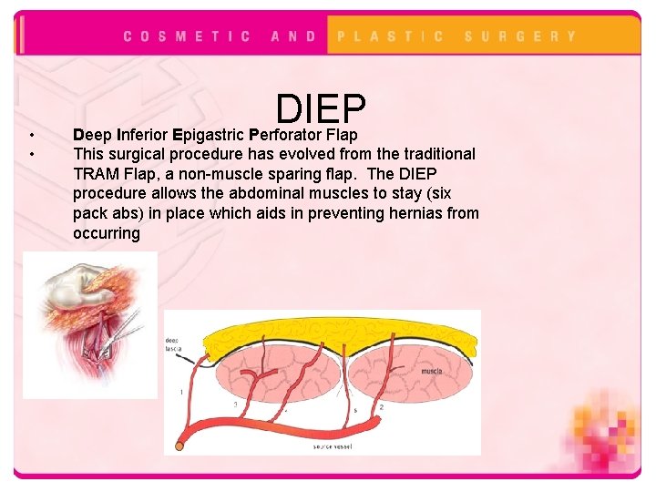  • • DIEP Deep Inferior Epigastric Perforator Flap This surgical procedure has evolved