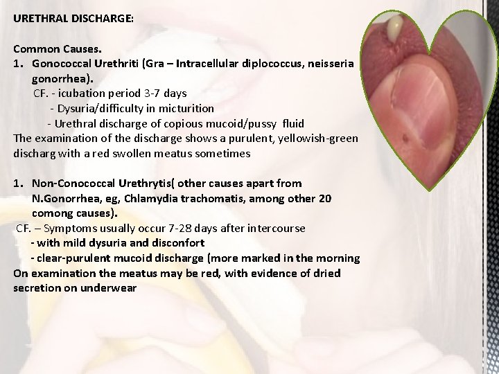 URETHRAL DISCHARGE: Common Causes. 1. Gonococcal Urethriti (Gra – Intracellular diplococcus, neisseria gonorrhea). CF.