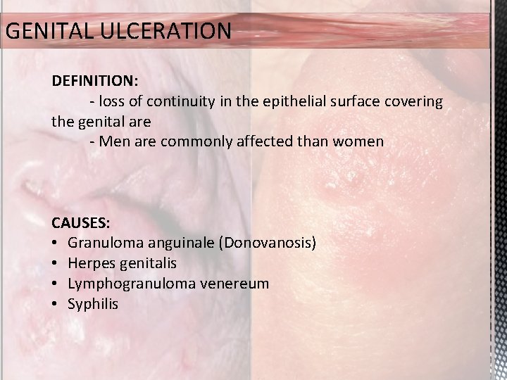 GENITAL ULCERATION DEFINITION: - loss of continuity in the epithelial surface covering the genital