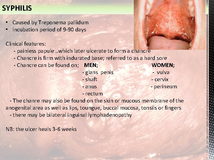 SYPHILIS • Caused by Treponema pallidum • Incubation period of 9 -90 days Clinical