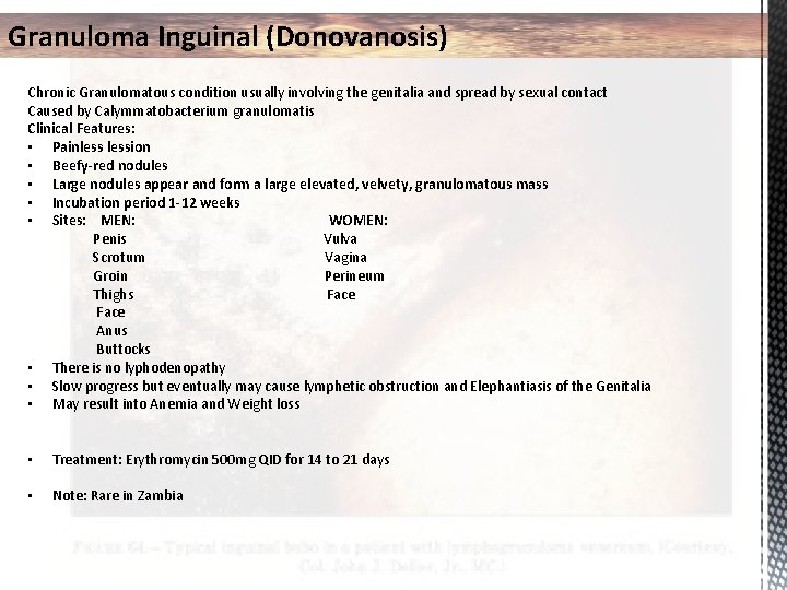 Granuloma Inguinal (Donovanosis) Chronic Granulomatous condition usually involving the genitalia and spread by sexual