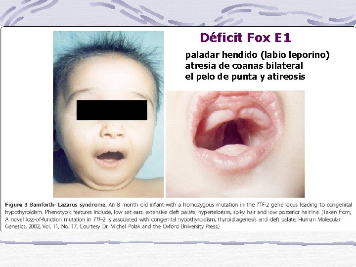 Déficit Fox E 1 paladar hendido (labio leporino) atresia de coanas bilateral el pelo