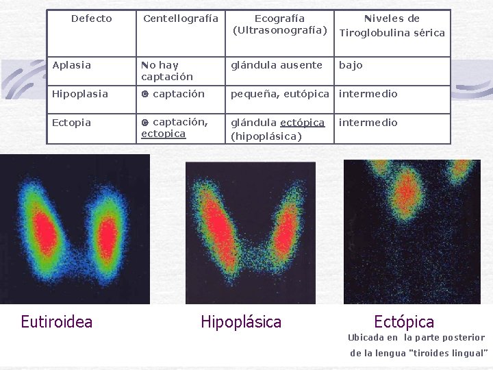 Defecto Centellografía Ecografía (Ultrasonografía) Niveles de Tiroglobulina sérica Aplasia No hay captación glándula ausente