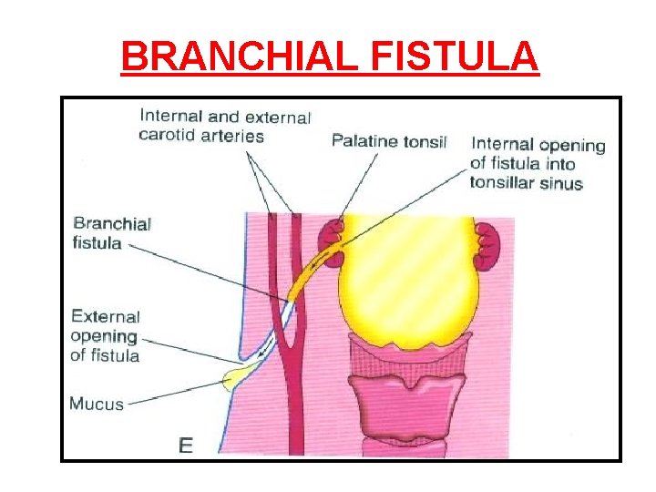 BRANCHIAL FISTULA 