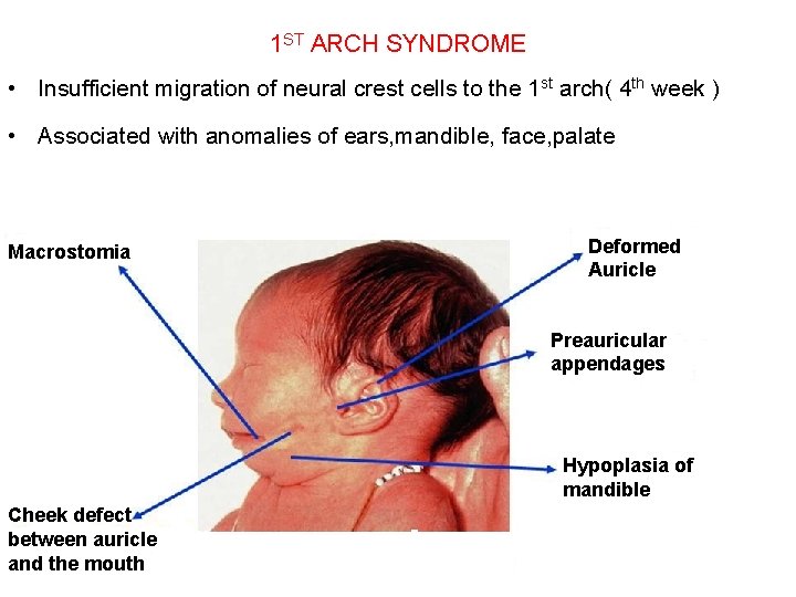 1 ST ARCH SYNDROME • Insufficient migration of neural crest cells to the 1