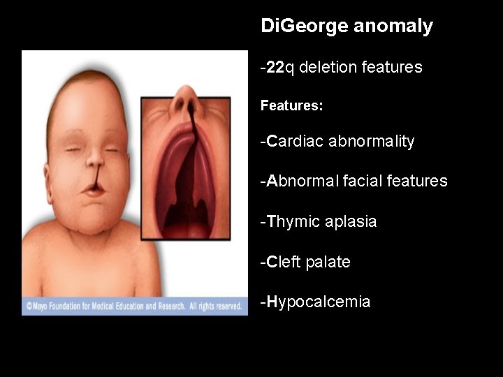 Di. George anomaly -22 q deletion features Features: -Cardiac abnormality -Abnormal facial features -Thymic