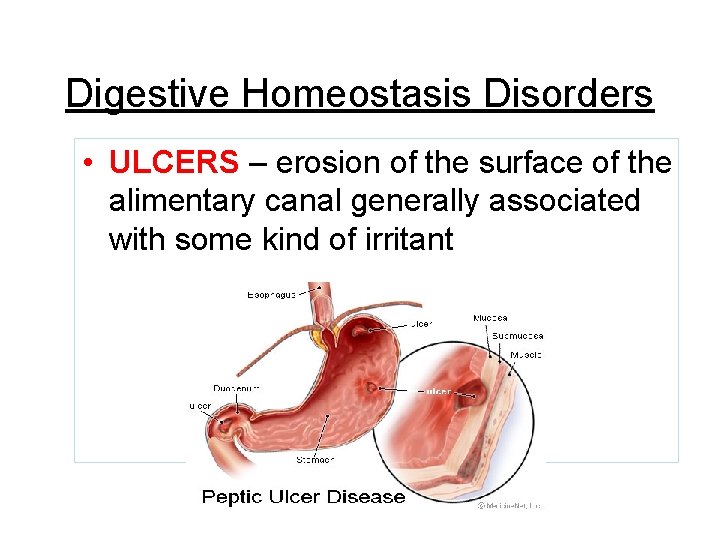 Digestive Homeostasis Disorders • ULCERS – erosion of the surface of the alimentary canal