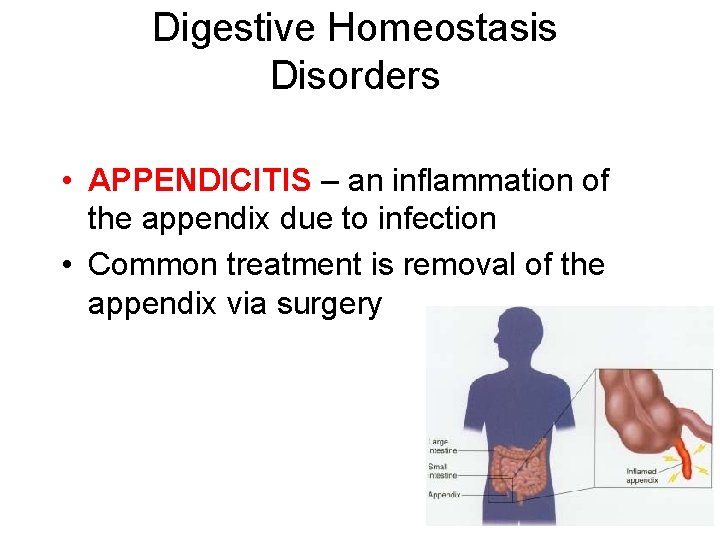 Digestive Homeostasis Disorders • APPENDICITIS – an inflammation of the appendix due to infection