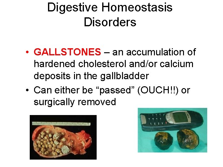 Digestive Homeostasis Disorders • GALLSTONES – an accumulation of hardened cholesterol and/or calcium deposits