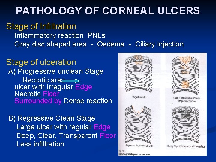PATHOLOGY OF CORNEAL ULCERS Stage of Infiltration Inflammatory reaction PNLs Grey disc shaped area