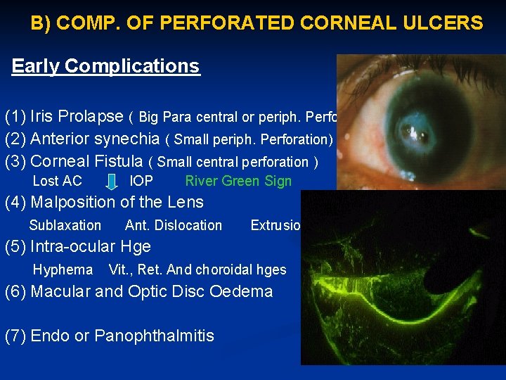 B) COMP. OF PERFORATED CORNEAL ULCERS Early Complications (1) Iris Prolapse ( Big Para