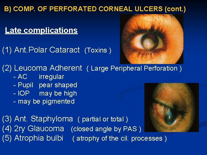 B) COMP. OF PERFORATED CORNEAL ULCERS (cont. ) Late complications (1) Ant. Polar Cataract