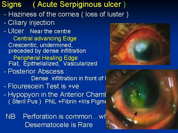 Signs ( Acute Serpiginous ulcer ) - Haziness of the cornea ( loss of
