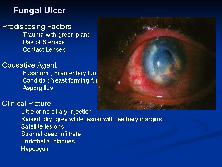 Fungal Ulcer Predisposing Factors Trauma with green plant Use of Steroids Contact Lenses Causative
