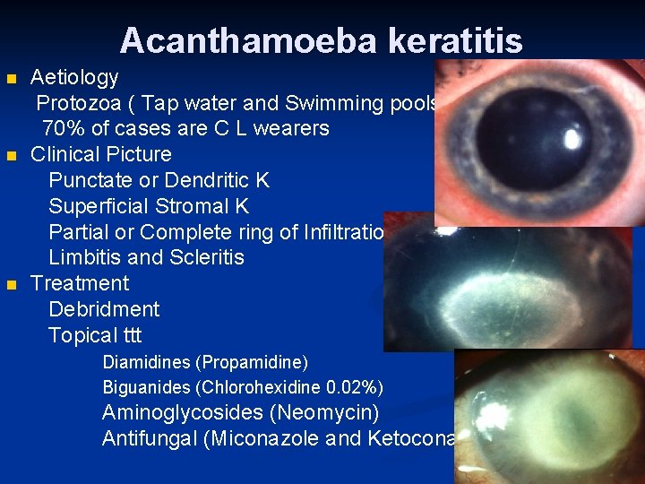 Acanthamoeba keratitis n n n Aetiology Protozoa ( Tap water and Swimming pools )