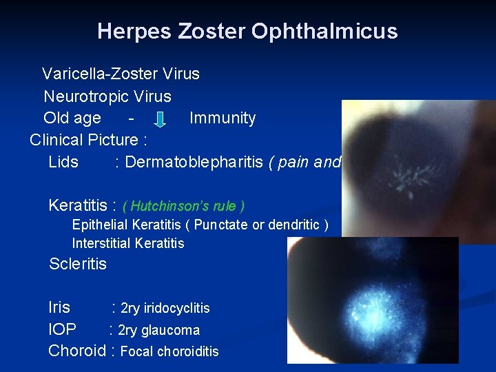 Herpes Zoster Ophthalmicus Varicella-Zoster Virus Neurotropic Virus Old age Immunity Clinical Picture : Lids