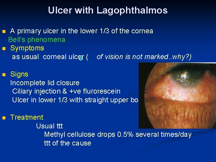 Ulcer with Lagophthalmos A primary ulcer in the lower 1/3 of the cornea Bell’s