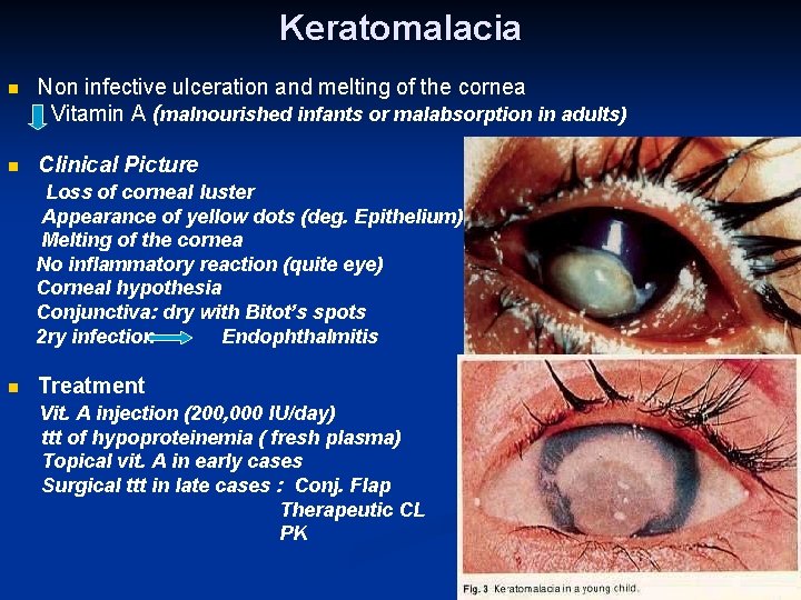 Keratomalacia n Non infective ulceration and melting of the cornea Vitamin A (malnourished infants