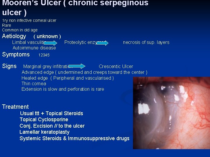 Mooren’s Ulcer ( chronic serpeginous ulcer ) 1 ry non infective corneal ulcer Rare