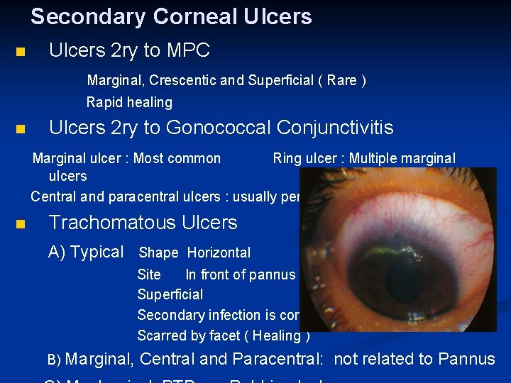 Secondary Corneal Ulcers n Ulcers 2 ry to MPC Marginal, Crescentic and Superficial (