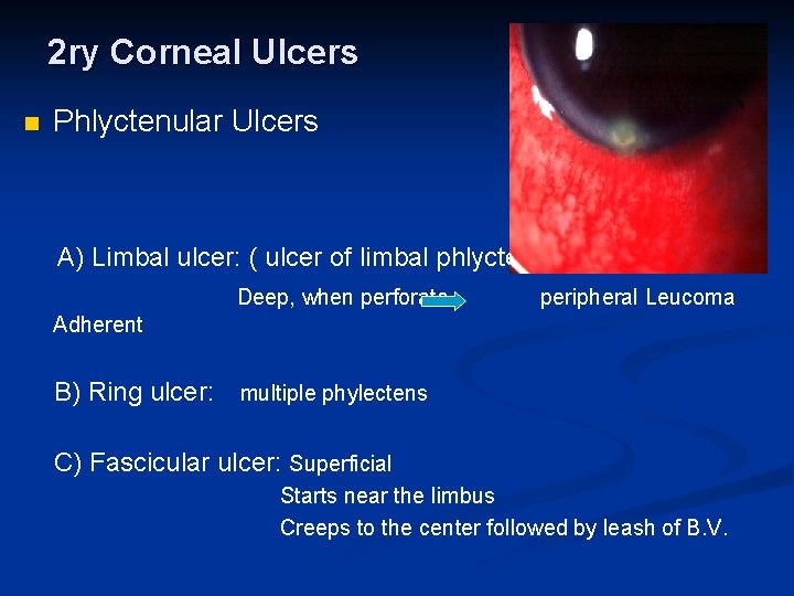 2 ry Corneal Ulcers n Phlyctenular Ulcers A) Limbal ulcer: ( ulcer of limbal