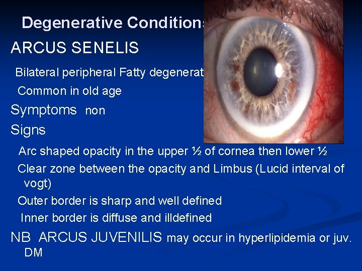 Degenerative Conditions ARCUS SENELIS Bilateral peripheral Fatty degeneration Common in old age Symptoms non