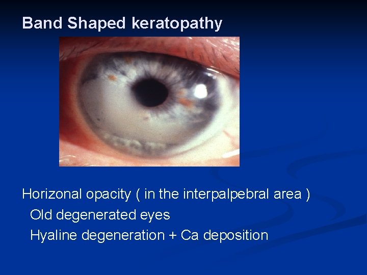 Band Shaped keratopathy Horizonal opacity ( in the interpalpebral area ) Old degenerated eyes