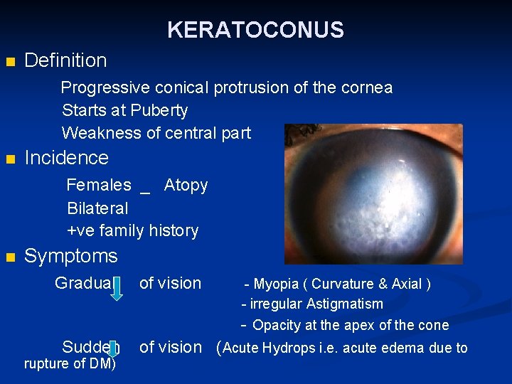 KERATOCONUS n Definition Progressive conical protrusion of the cornea Starts at Puberty Weakness of