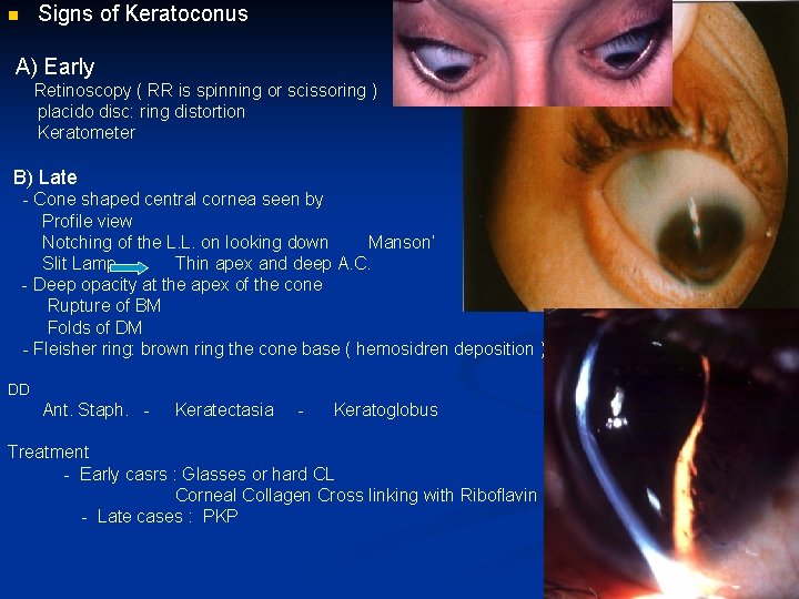 Signs of Keratoconus n A) Early Retinoscopy ( RR is spinning or scissoring )