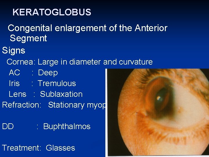 KERATOGLOBUS Congenital enlargement of the Anterior Segment Signs Cornea: Large in diameter and curvature