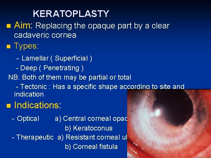 n n KERATOPLASTY Aim: Replacing the opaque part by a clear cadaveric cornea Types: