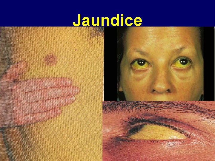 Jaundice 