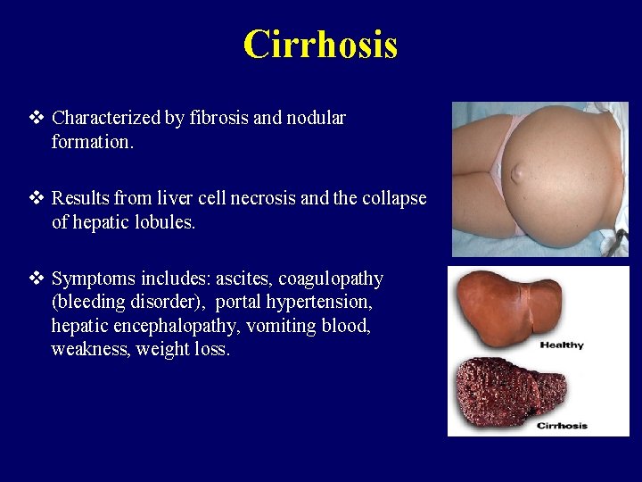 Cirrhosis v Characterized by fibrosis and nodular formation. v Results from liver cell necrosis