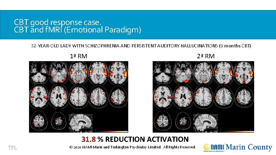 CBT good response case. CBT and f. MRI (Emotional Paradigm) 32 -YEAR-OLD LADY WITH