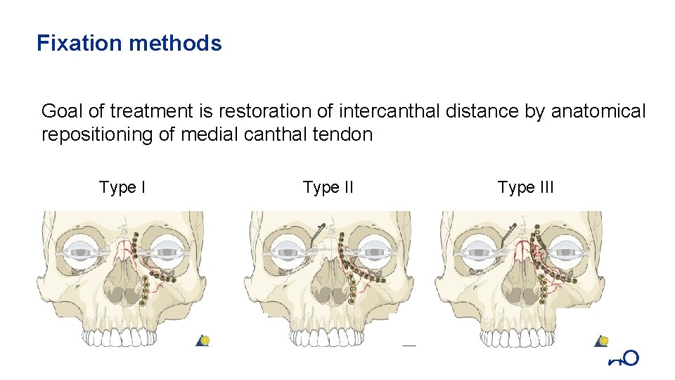 Fixation methods Goal of treatment is restoration of intercanthal distance by anatomical repositioning of