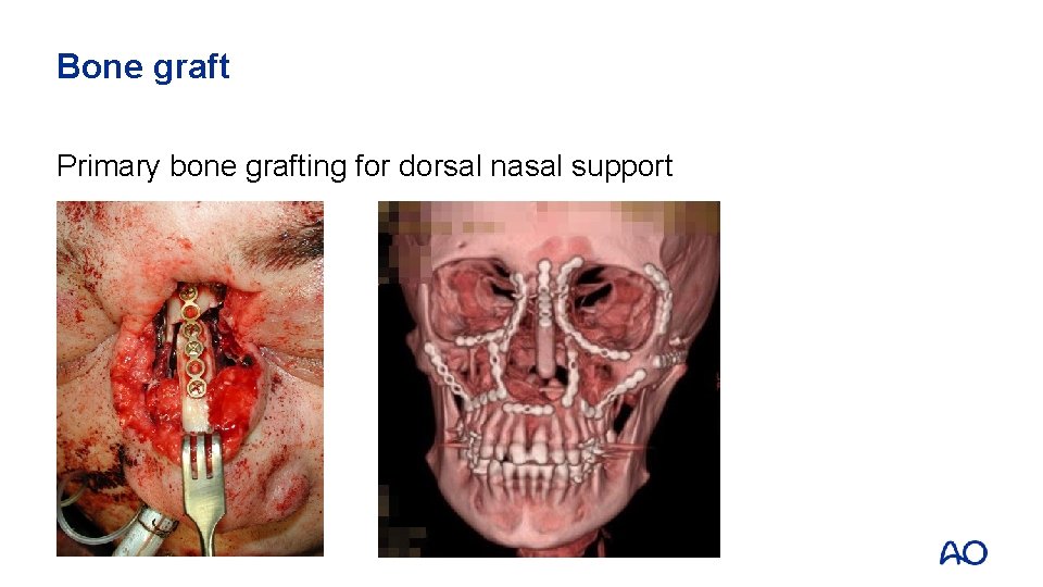 Bone graft Primary bone grafting for dorsal nasal support 