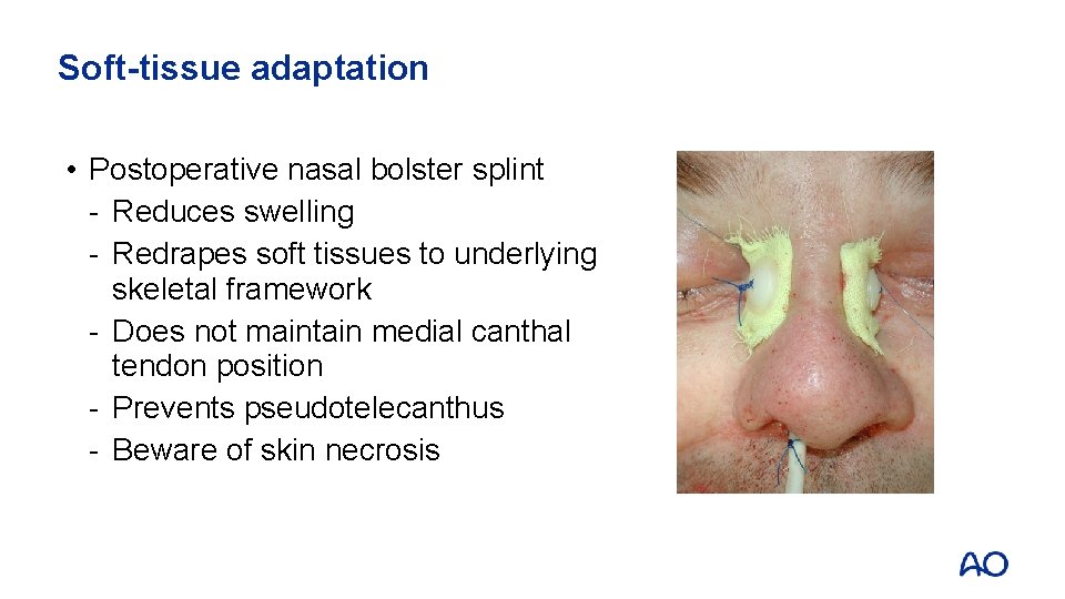Soft-tissue adaptation • Postoperative nasal bolster splint - Reduces swelling - Redrapes soft tissues