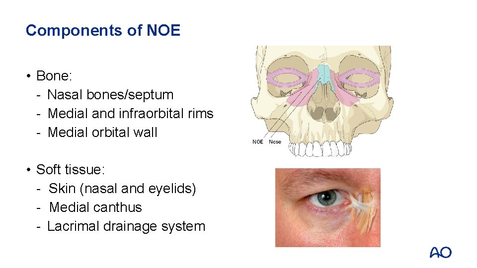 Components of NOE • Bone: - Nasal bones/septum - Medial and infraorbital rims -