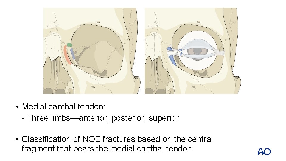  • Medial canthal tendon: - Three limbs—anterior, posterior, superior • Classification of NOE