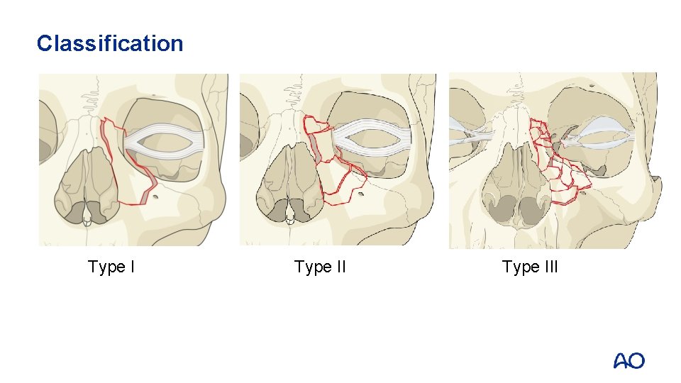 Classification Type III 