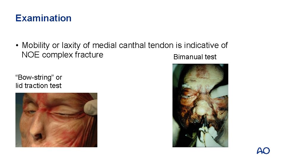 Examination • Mobility or laxity of medial canthal tendon is indicative of NOE complex