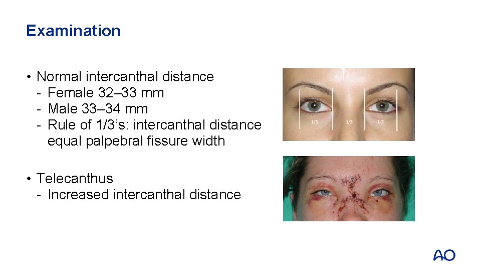 Examination • Normal intercanthal distance - Female 32‒ 33 mm - Male 33‒ 34