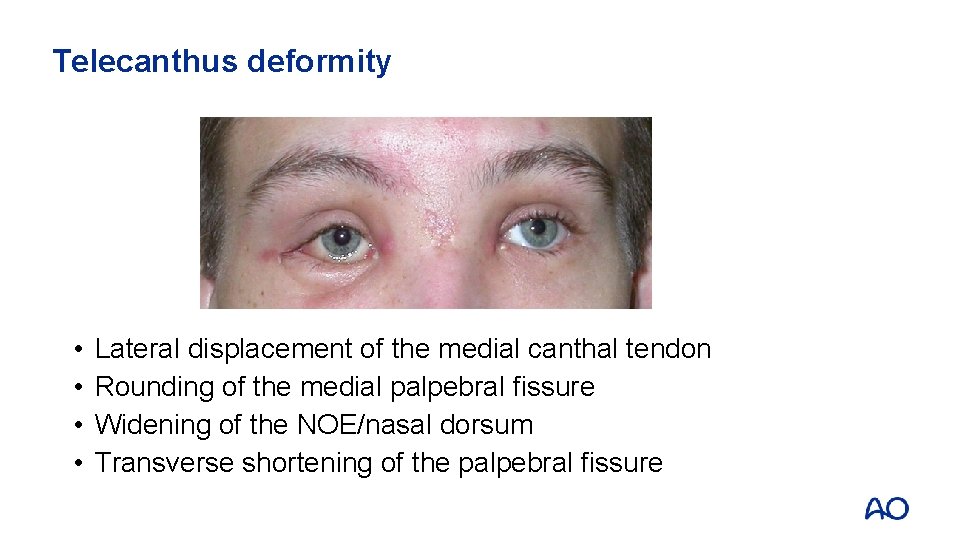 Telecanthus deformity • • Lateral displacement of the medial canthal tendon Rounding of the